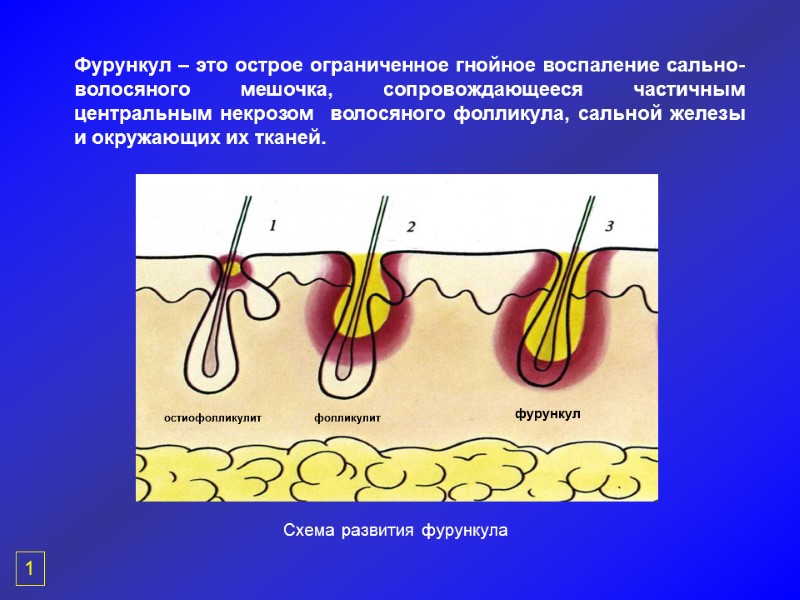 Фурункул – это острое ограниченное гнойное воспаление сально-волосяного мешочка, сопровождающееся частичным  центральным некрозом